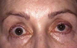 Lật mi sau khi tạo mắt hai mí