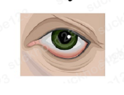 Lật mí sau cắt mí dưới và cách xử lý