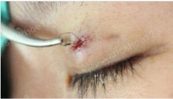 Lộ nút thắt chỉ, tuột chỉ sau khi tạo mắt hai mí