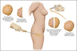 Lợi ích từ việc kết hợp hút mỡ và cấy mỡ tự thân