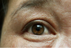 Tạo hình mí mắt lão hóa, chảy xệ ở người có tuổi và những lưu ý