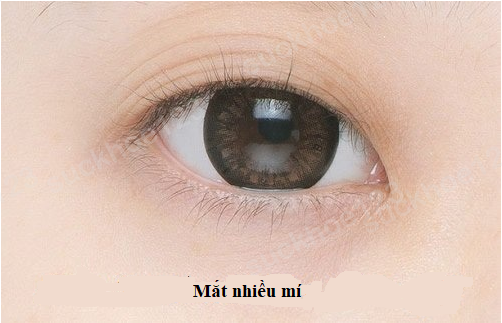 Mắt nhiều mí (3 mí): nguyên nhân và cách chỉnh sửa