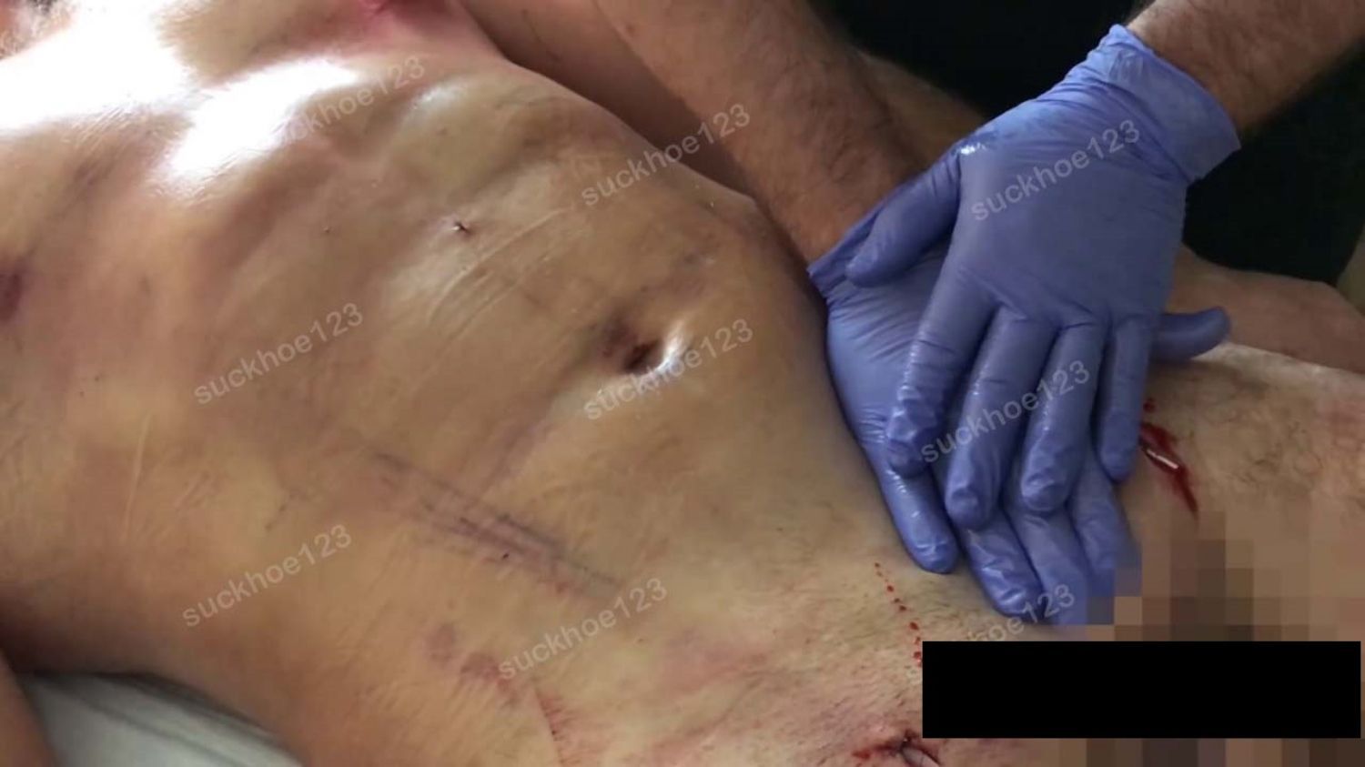 Mát-xa sau hút mỡ có tác dụng gì?