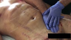 Mát-xa sau hút mỡ có tác dụng gì?