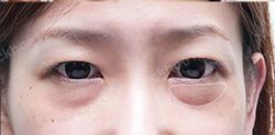 Mí mắt không cân sau cắt mí dưới