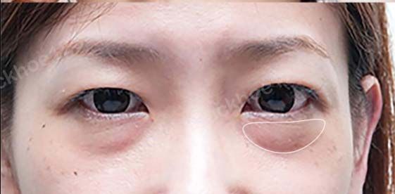 Mí mắt không cân sau cắt mí dưới