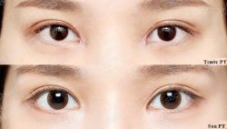 Mở Góc Mắt Trong