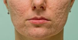 Mụn cám và mụn đầu đen cũng có thể để lại sẹo