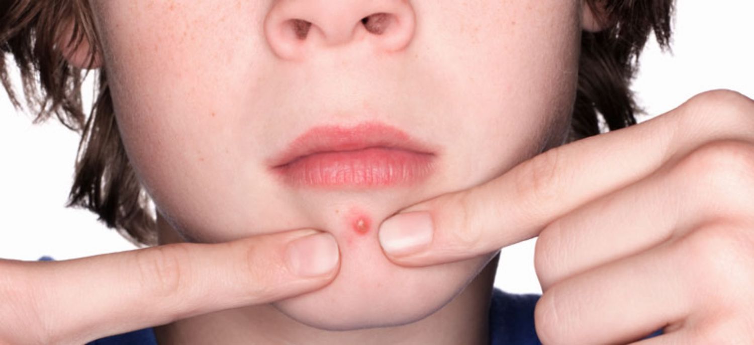 Mụn trứng cá ở trẻ nhỏ