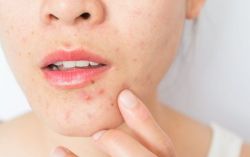 Có phải stress gây mụn trứng cá không?