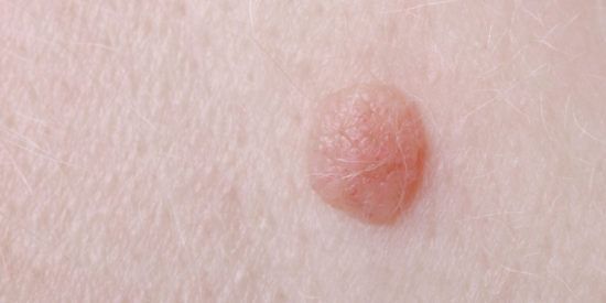 Nên làm gì khi bị mụn cóc?