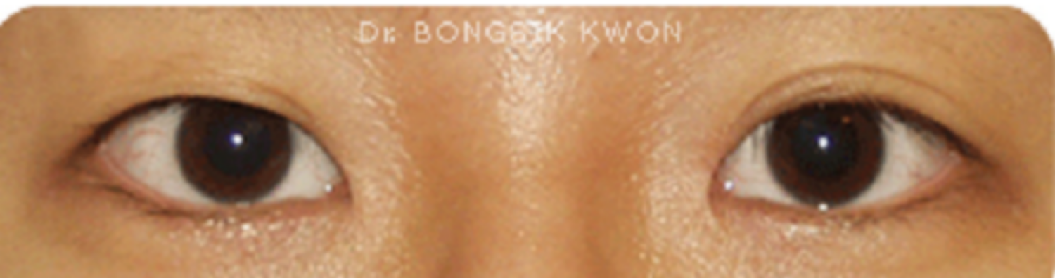 Nếp mí nông và biến mất sau khi tạo mắt hai mí