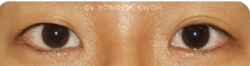 Nếp mí nông và biến mất sau khi tạo mắt hai mí