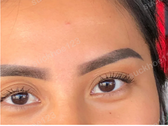 Nếp mí không đều sau khi tạo mắt hai mí