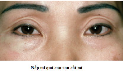 Nếp mí quá cao sau phẫu thuật cắt mí (nếp mí to)