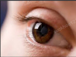 Nếp mí quá sâu sau phẫu thuật cắt mí