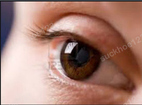 Nếp mí quá sâu sau phẫu thuật cắt mí