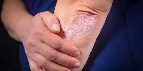 Những bước cơ bản để kiểm soát bệnh chàm