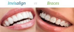 Lựa chọn thay thế cho niềng răng kim loại truyền thống: Invisalign hay niềng Damon?