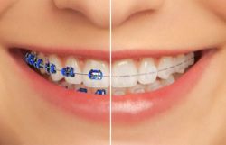 Niềng răng: mắc cài có màu và mắc cài trong suốt
