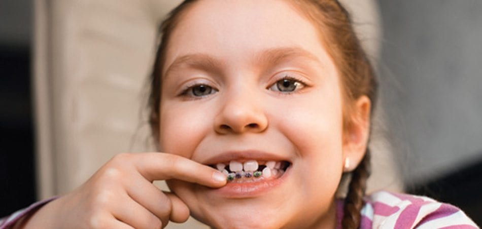 Niềng răng có thể thu hẹp khoảng cách lớn do mất răng không?