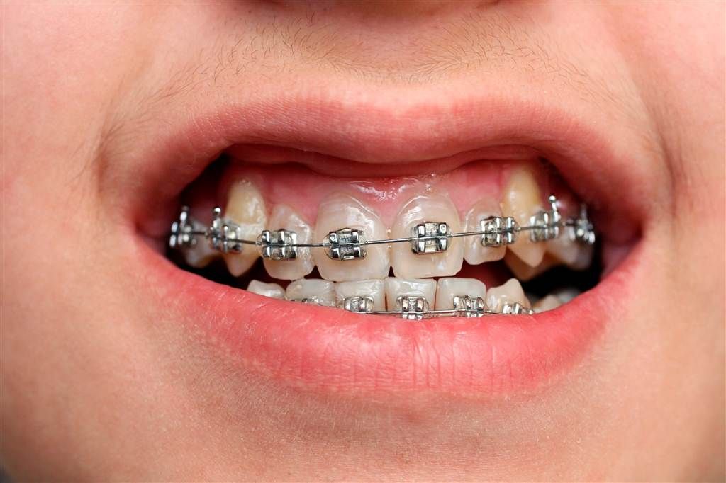 Niềng răng không chỉ tác động đến nụ cười của trẻ
