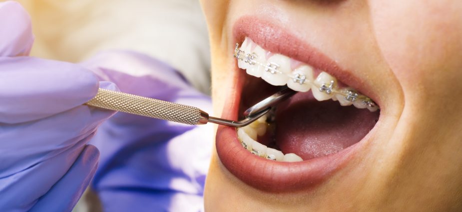 Niềng răng có làm cho chân răng ngắn đi không?