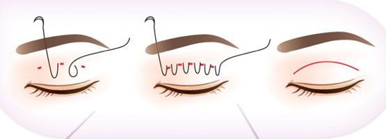 Bấm mí luồn chỉ tạo mắt hai mí