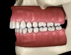 Khớp cắn sâu là gì? Nên niềng răng hay phẫu thuật cắt chỉnh hàm?