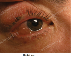 Phù kết mạc sau khi cắt mí dưới