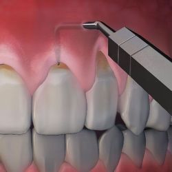 Phẫu thuật lợi Pinhole