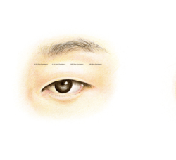 Quặm mi sau phẫu thuật sụp mí