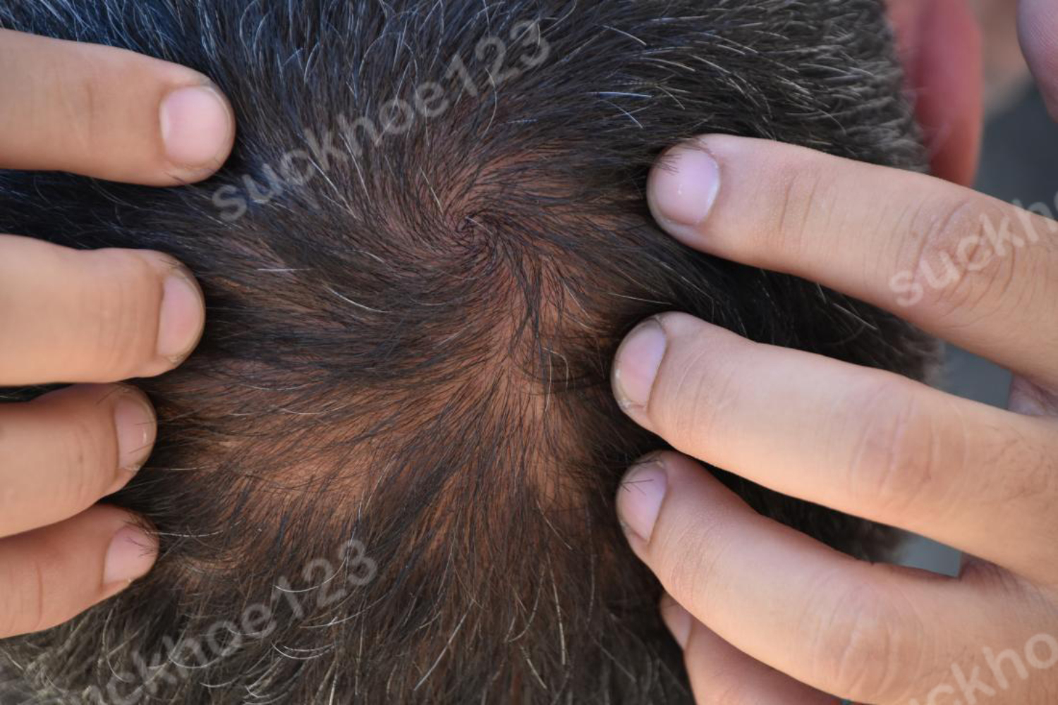 Rụng tóc lan tỏa TE (Telogen effuvium)