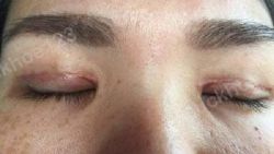 Sẹo lộ sau khi tạo mắt hai mí