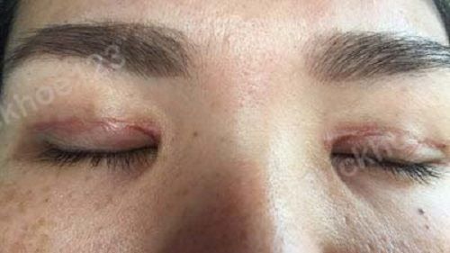 Sẹo lộ sau khi tạo mắt hai mí