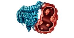 Việc súc ruột có tác dụng trị mụn không?