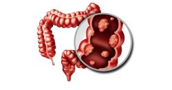 Thải độc đường ruột có tác dụng trị mụn không?