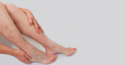 6 yếu tố nguy cơ hàng đầu của bệnh suy tĩnh mạch mạn tính