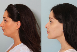 Các phương pháp tạo hình cằm