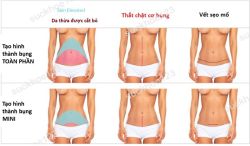 Tạo hình thành bụng mini