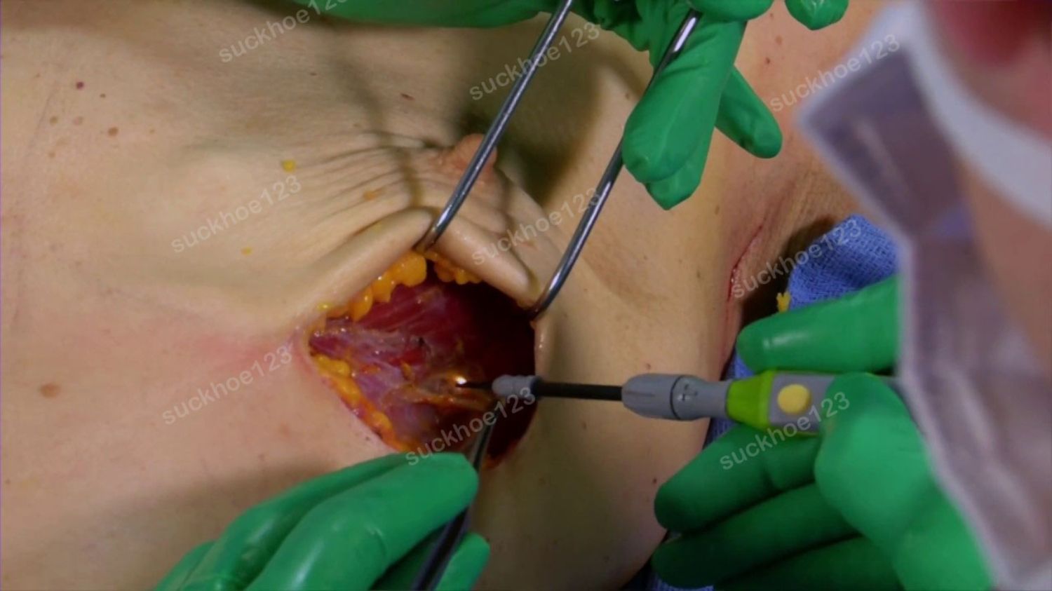 Cách tạo khoang chứa túi độn chính xác trong quá trình phẫu thuật nâng ngực