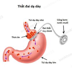 Thắt đai dạ dày (Gastric banding)