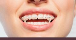 Thun kéo có tác dụng gì trong quá trình niềng răng?
