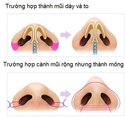 Thu gọn cánh mũi: cắt cánh mũi, cuộn cánh mũi hay tiêm chất làm đầy?