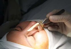 Tháo sụn sau nâng mũi có phức tạp không?