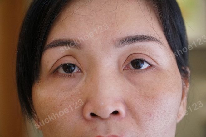 Lỡ sai lầm cắt mí quá to, phải làm sao?