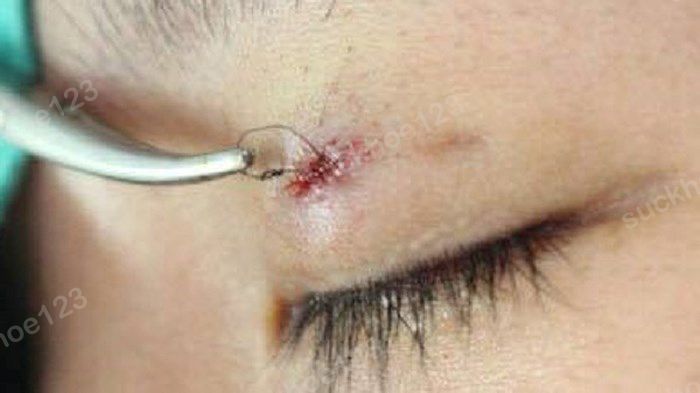 Nhấn mí bị tuột chỉ, lòi chỉ có sao không?