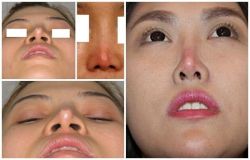 Chỉnh sửa mũi hỏng sau nâng mất bao lâu mới bình thường trở lại?