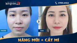 Có nên nâng mũi trước rồi mới cắt mí?