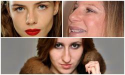 Giải pháp triệt để thay thế chiếc mũi dài, nhọn bằng chiếc mũi thon mềm mại